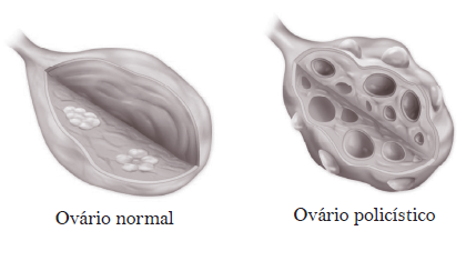 Cistos